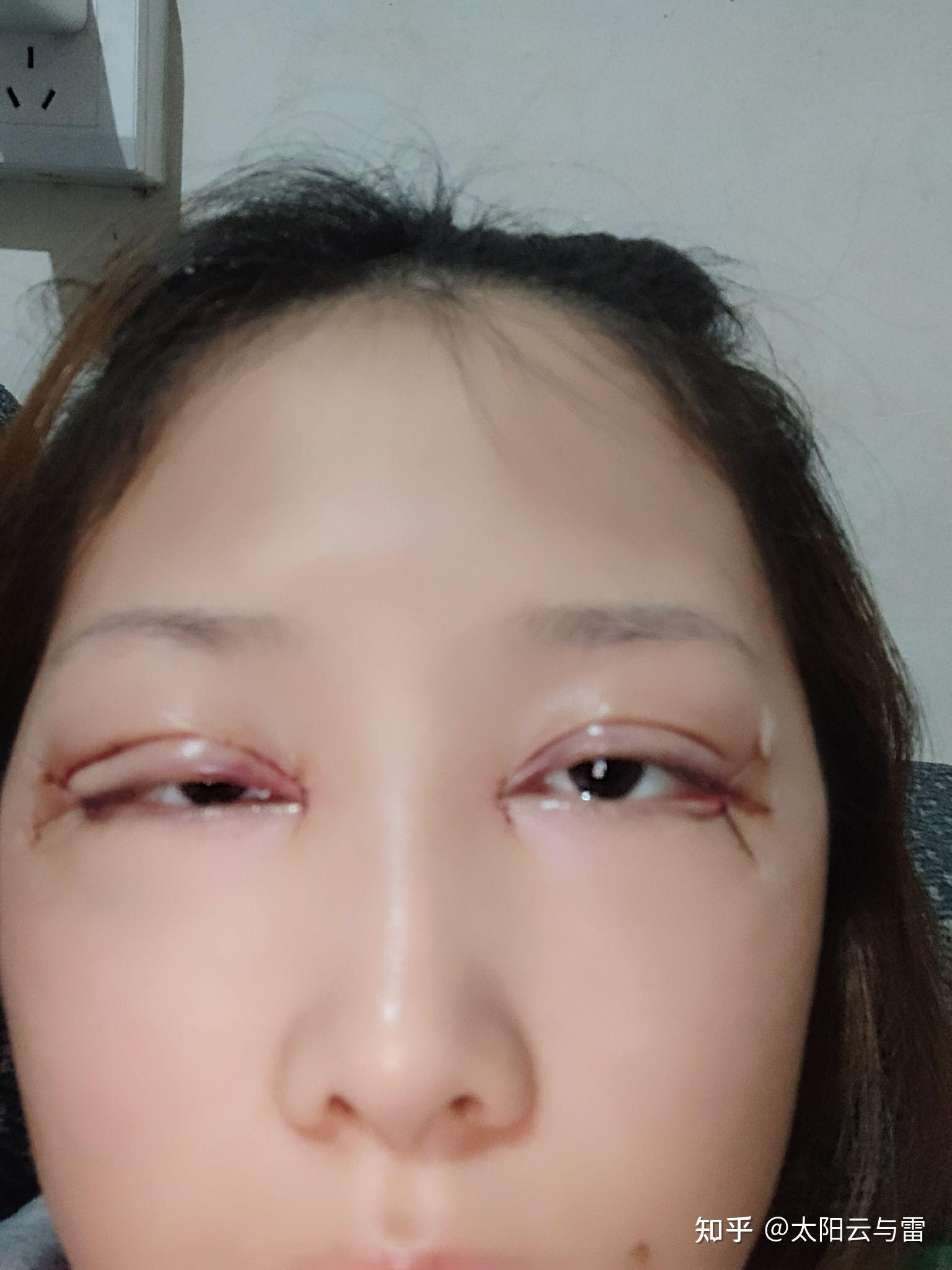 双眼皮手术 - 知乎