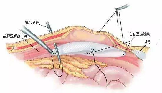 成年人疝气怎样治疗