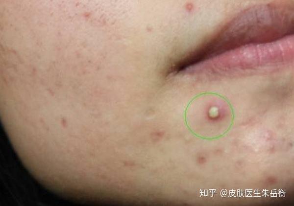 目前最为合理的解释 痘痘能挤吗 知乎