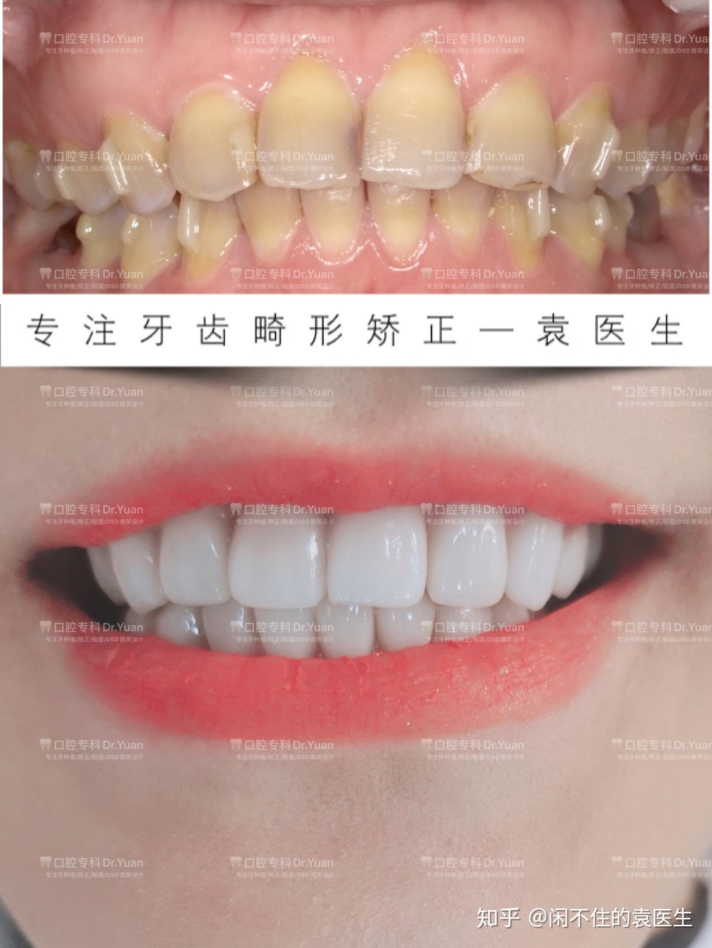 重度四环素牙的瓷贴面微创牙齿美容病例 - 牙齿美容 - 看牙有道|佛山南海王琪牙科博客