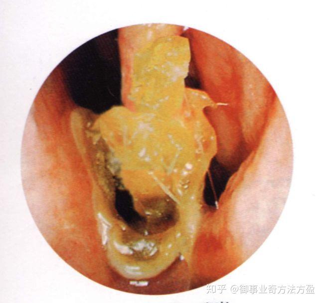 鼻窦炎鼻腔内部图片图片