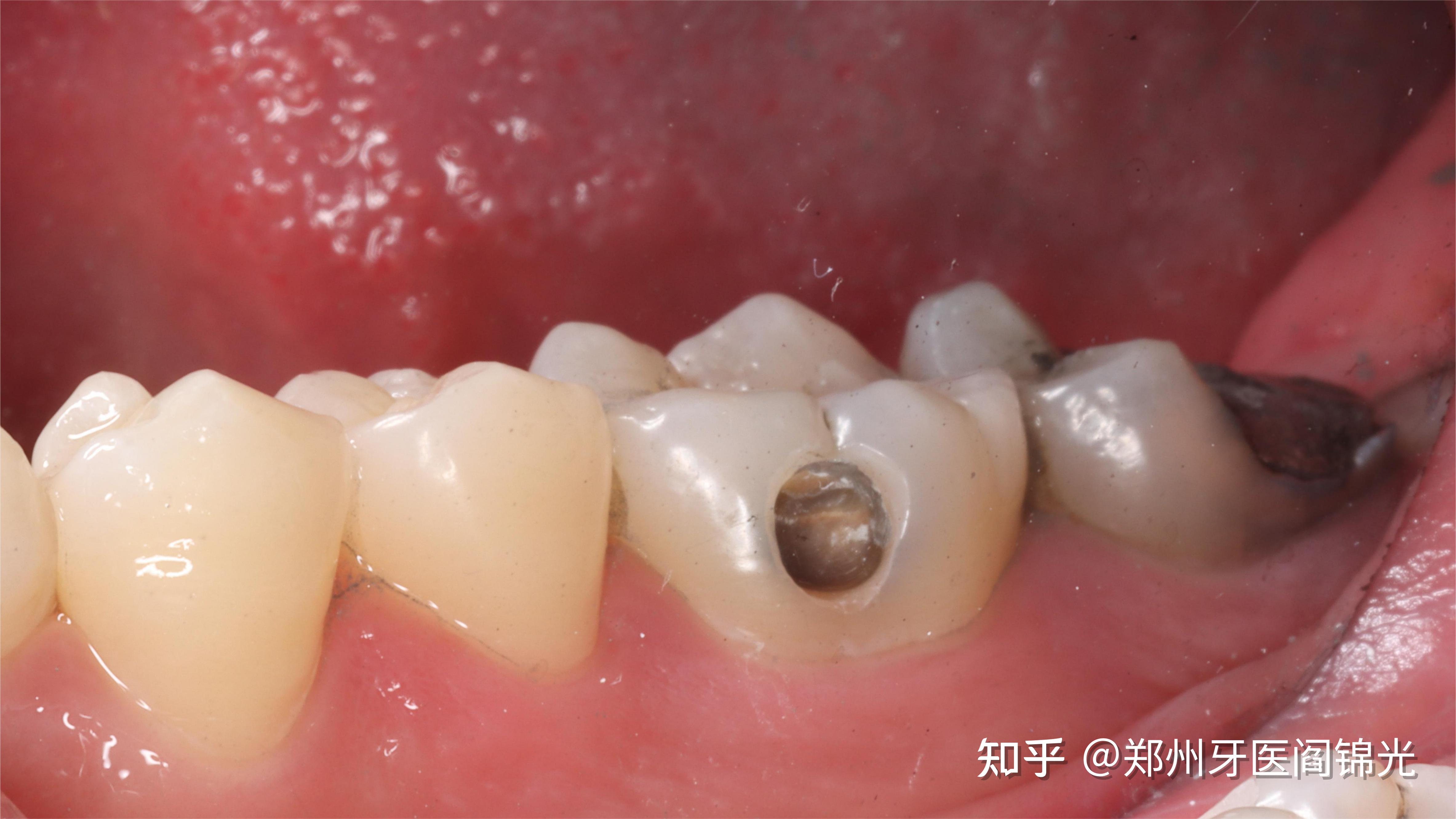 左下36牙,6年前用银汞合金补牙,现在窝洞边缘有墨浸状改变