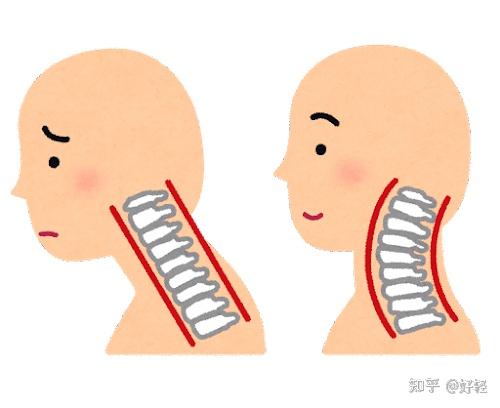 颈项强直的表现的图片图片