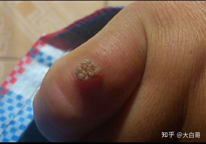 扁平疣瘊子是怎么引起的呢