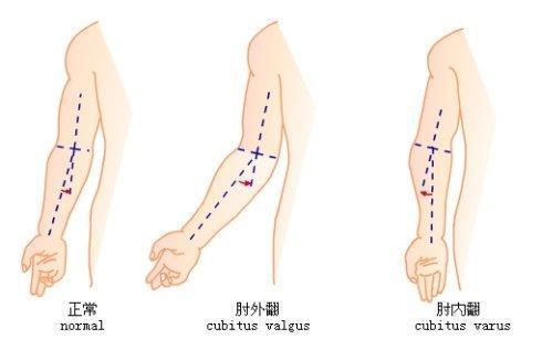 骨折复位不良 手臂这种畸形很可怕 知乎