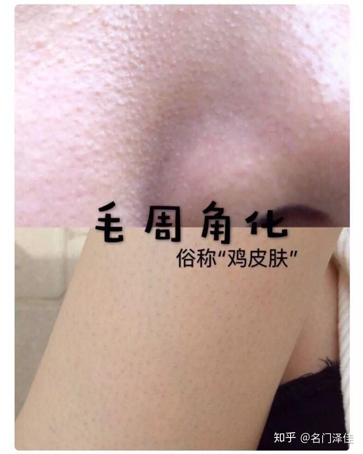 脸眼下鸡皮肤怎么去除(脸部鸡皮肤怎么消除最有效)