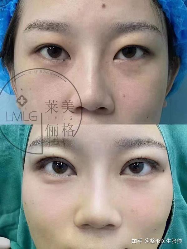 内双与单眼皮割双眼皮有不同吗?一单一双能只做一边吗? - 知乎