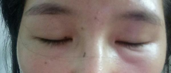 下眼袋突然肿起来是什么回事 知乎