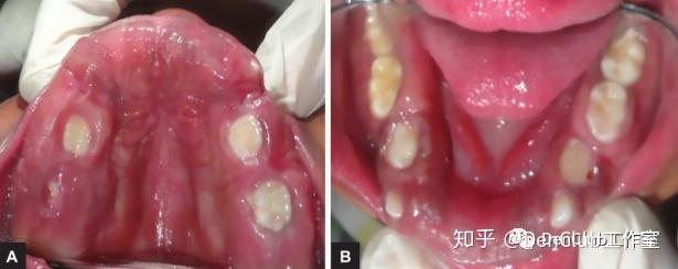 【你可能不知道的口腔遗传性疾病】今日分享の遗传性牙龈纤维瘤病