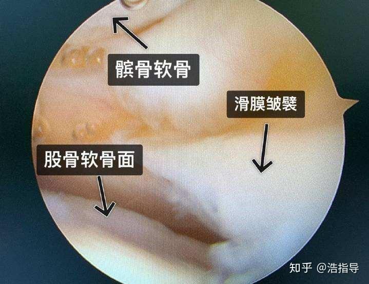 鵝足滑囊炎縫匠肌,股薄肌和半腱肌的肌腱在脛骨近端的內側面形成聯合