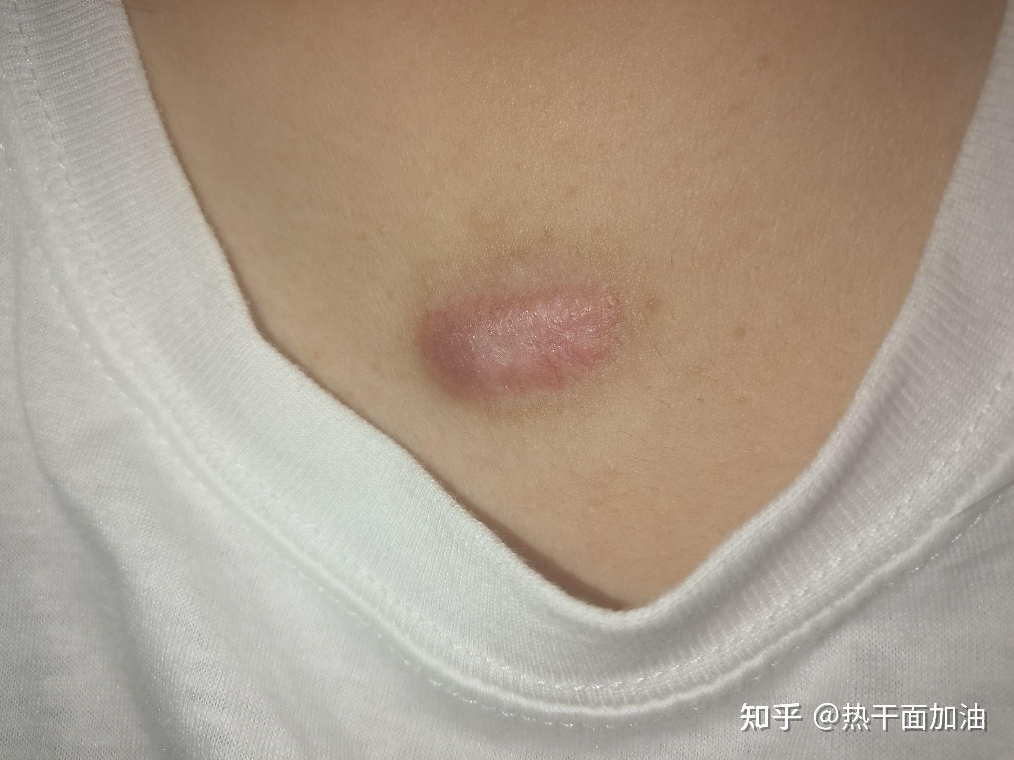 疤痕疙瘩治疗
