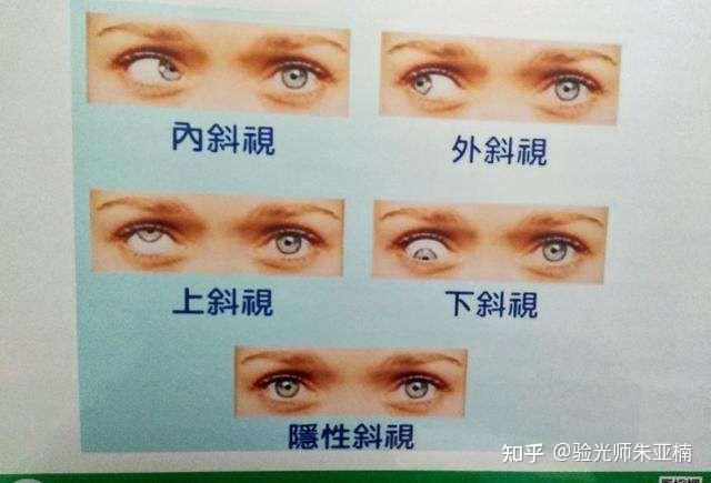 今天我们就来谈一谈和斜视有关的一些小知识