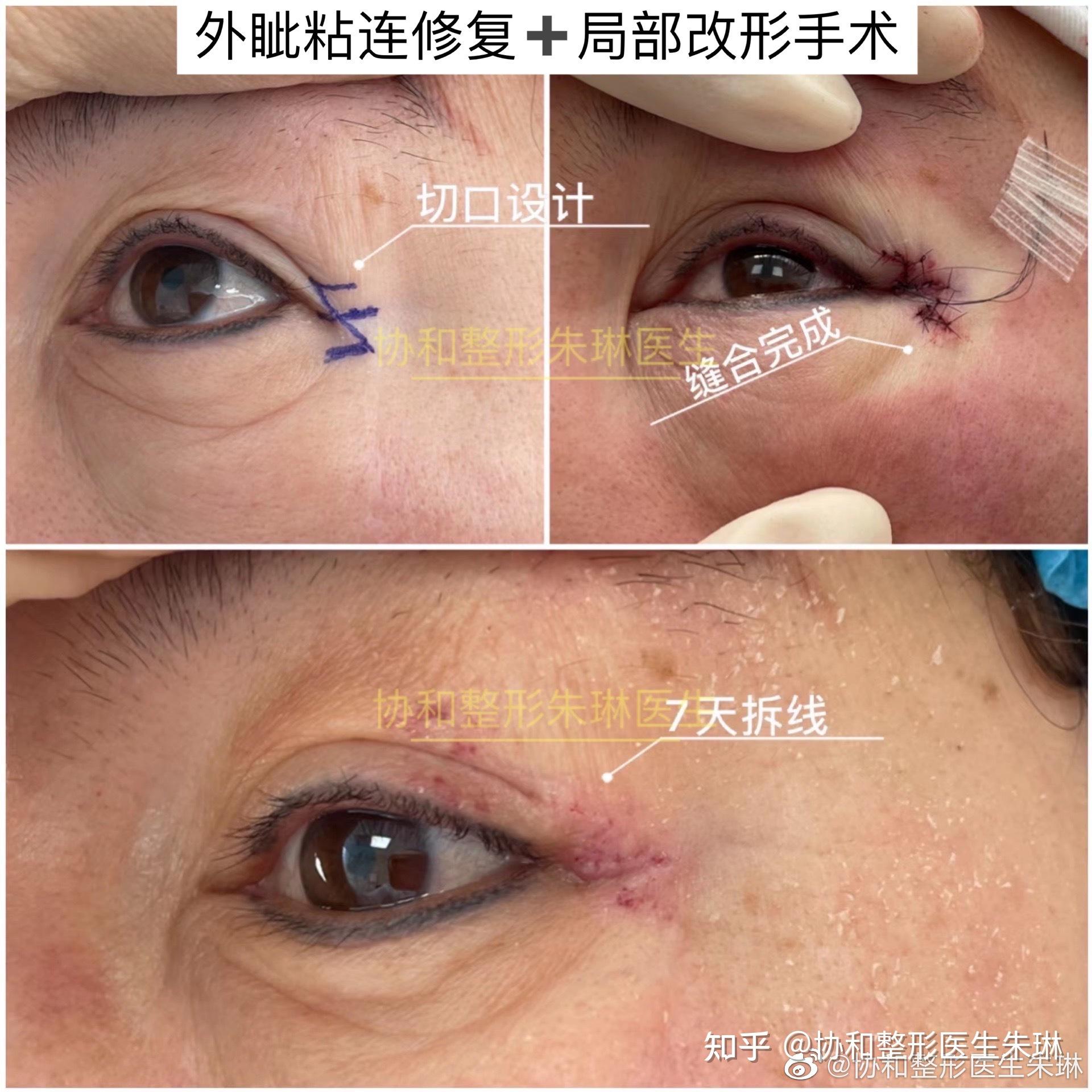 北京外伤后外眼角畸形修复案例