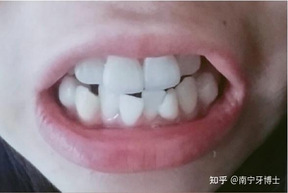 专业正畸 | 歪牙星人,别让自己丑太久!