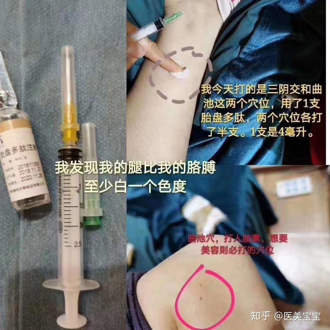 人胎素注射方法位置图图片