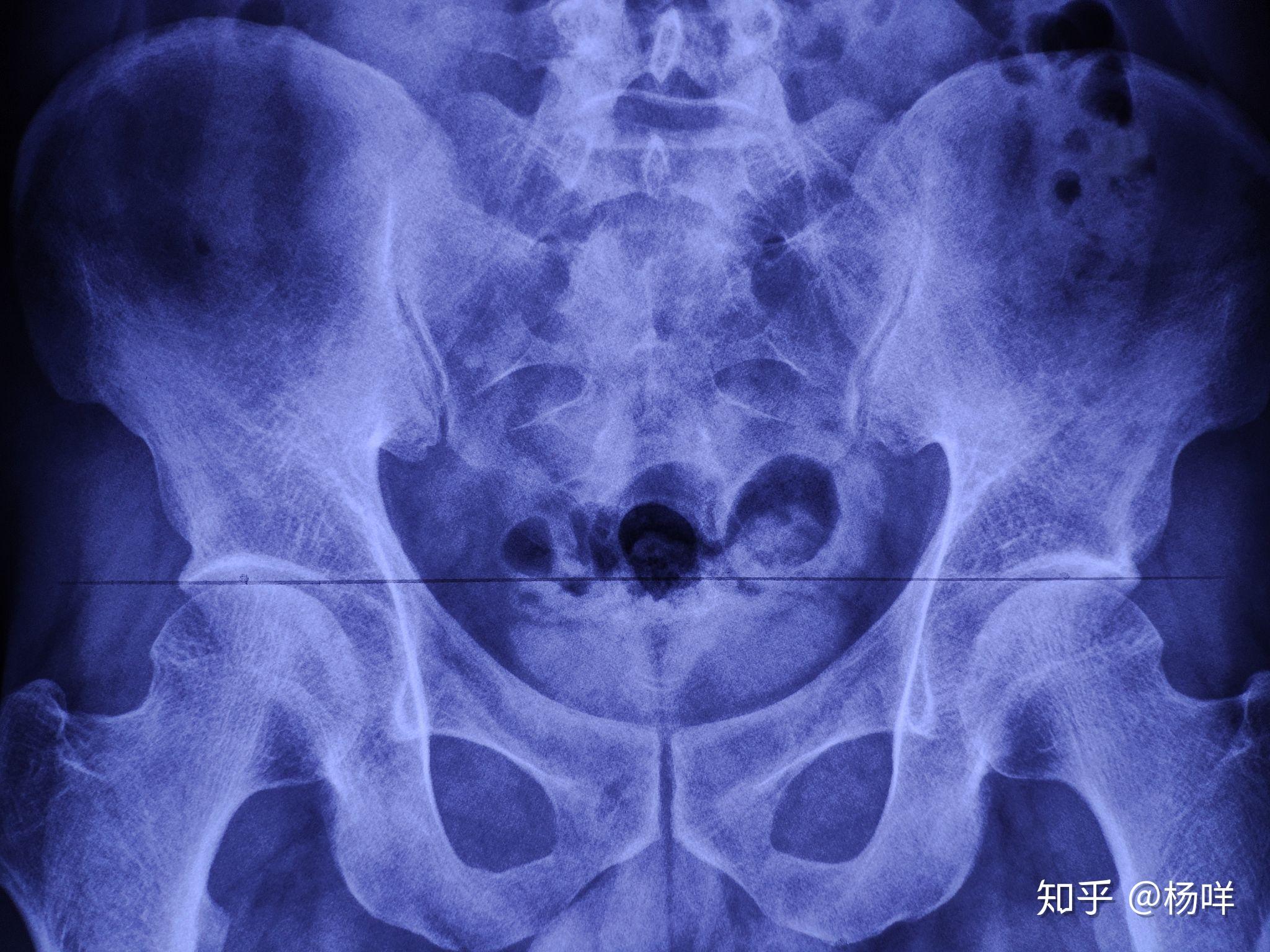 正常的女性骨盆x光片图片