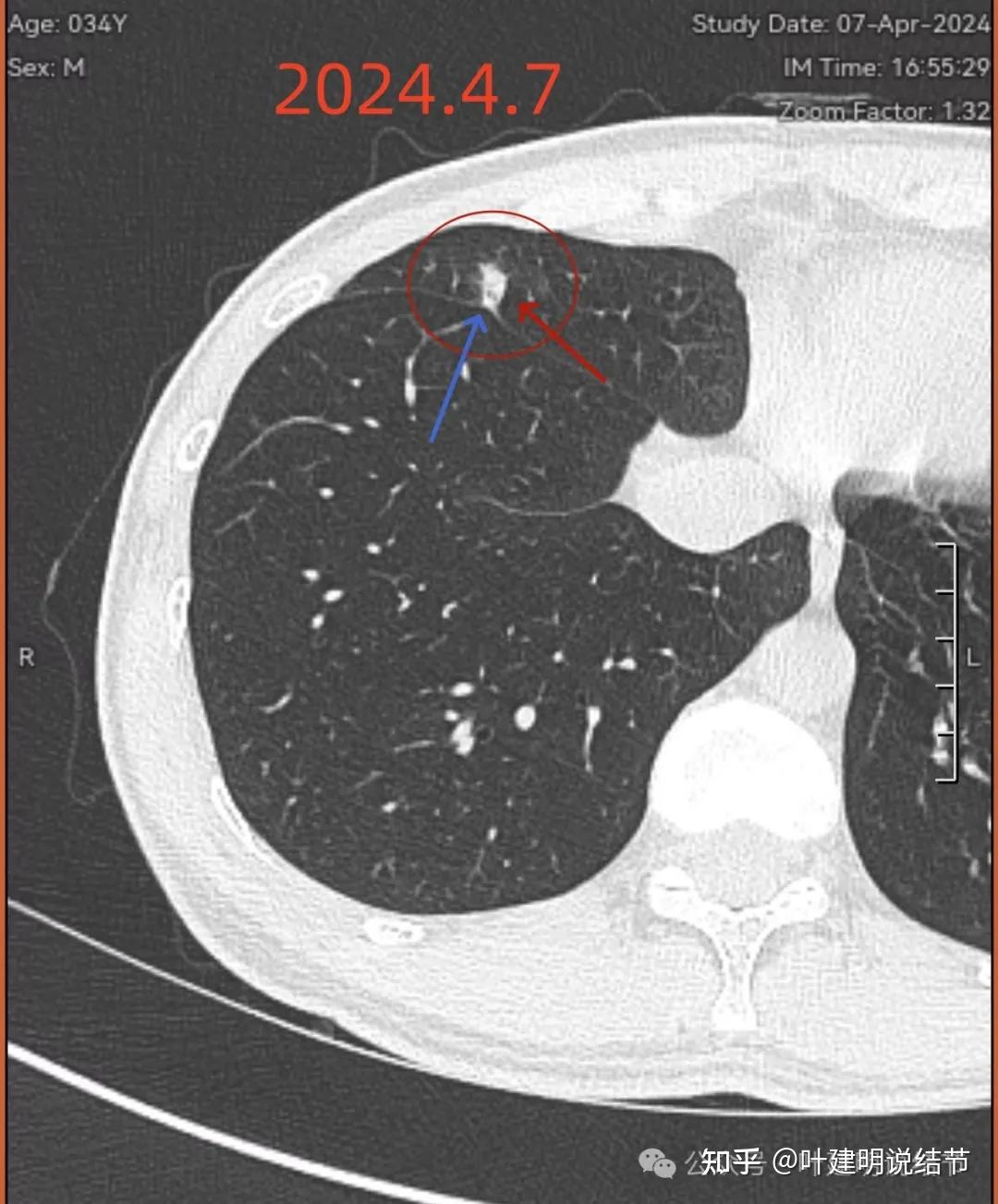 肺结节病灶图片