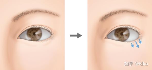 顕微鏡下眼形成手術 = OCULOPLASTIC SURGERY THROUG…-