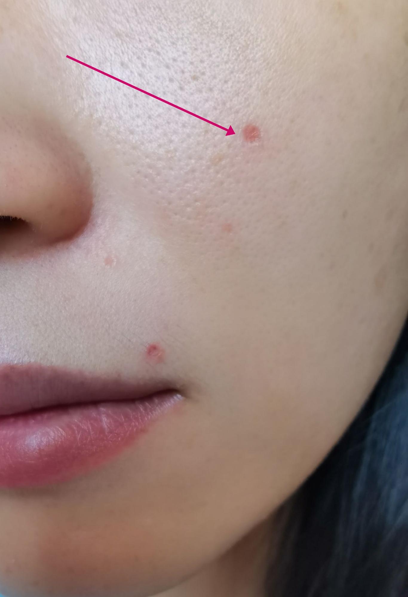 记录激光去痣 - 知乎