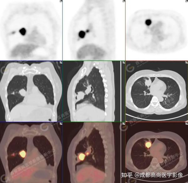 【高尚病例】PET/CT病例：原发性肺印戒细胞癌1例 - 知乎