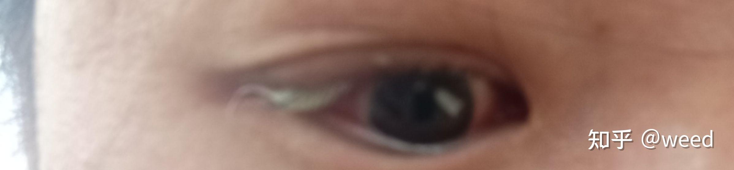 我眼睛里长了皮样脂肪瘤,和大家分享一下我从检查到手术自己术后恢复