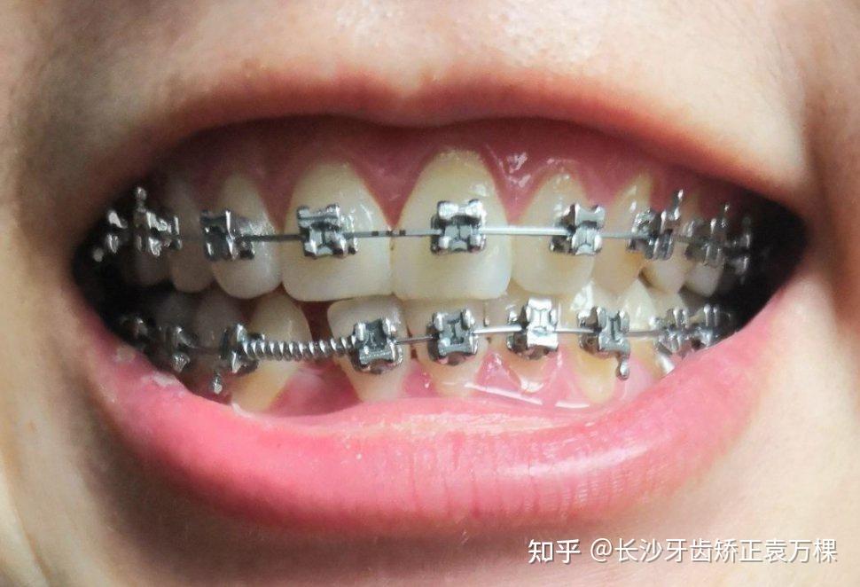 这就是矫正过程中的弹簧作用,你了解了吗?#长沙牙齿矫正##长沙正畸