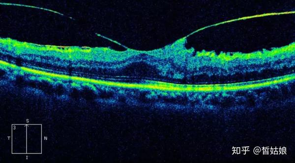 诊断眼底病变利器 光学相干断层扫描如何检查患者眼底 知乎
