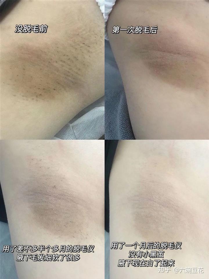 女性怎么给私处脱毛最安全哪种私处脱毛方式最有效