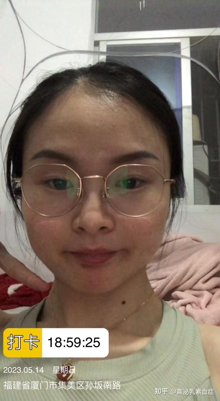 手术切痣嘴角下方痣(好吃痣) 坐标:厦门