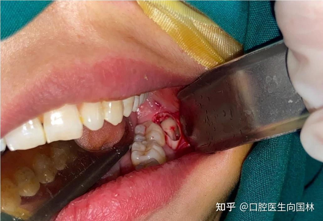 患者诉近半年来左下后牙反复不适,1月前拍片发现左侧下颌智齿阻生,未