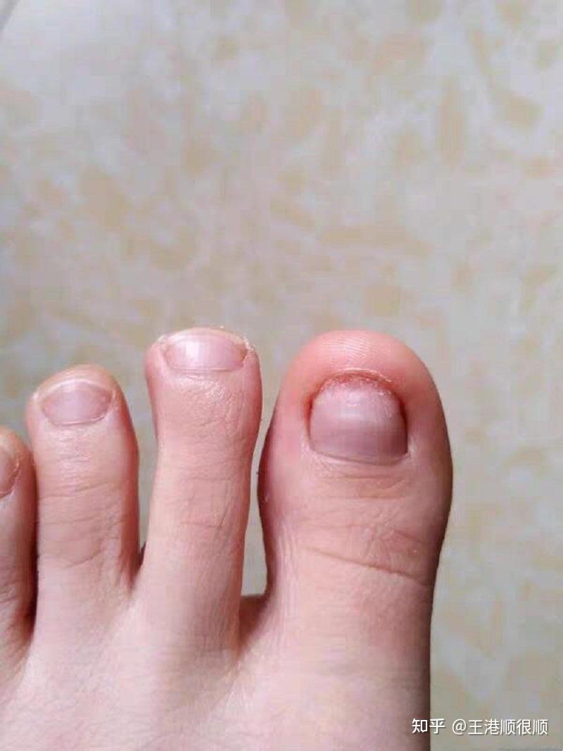 灰指甲怎么治疗可以根治吗