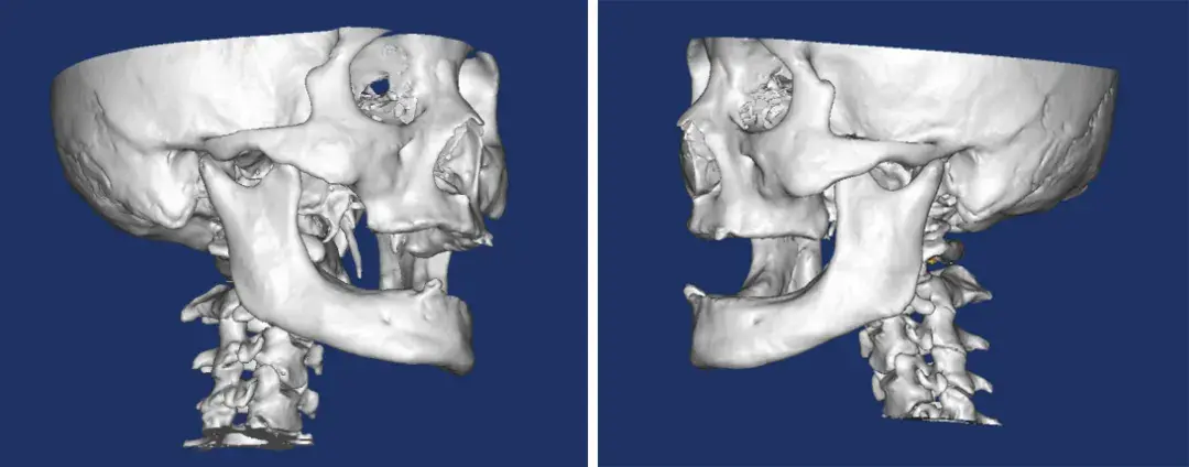 云仟佰3d打印技术成功帮助重庆患者完成肿瘤切除和骨移植手术