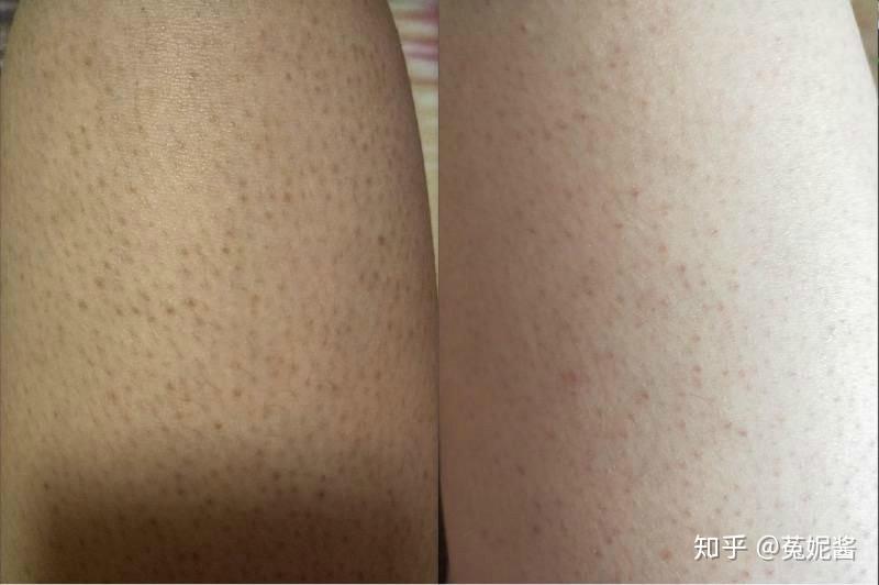 怎么淡化遗传鸡皮肤(遗传鸡皮肤可以根治吗)
