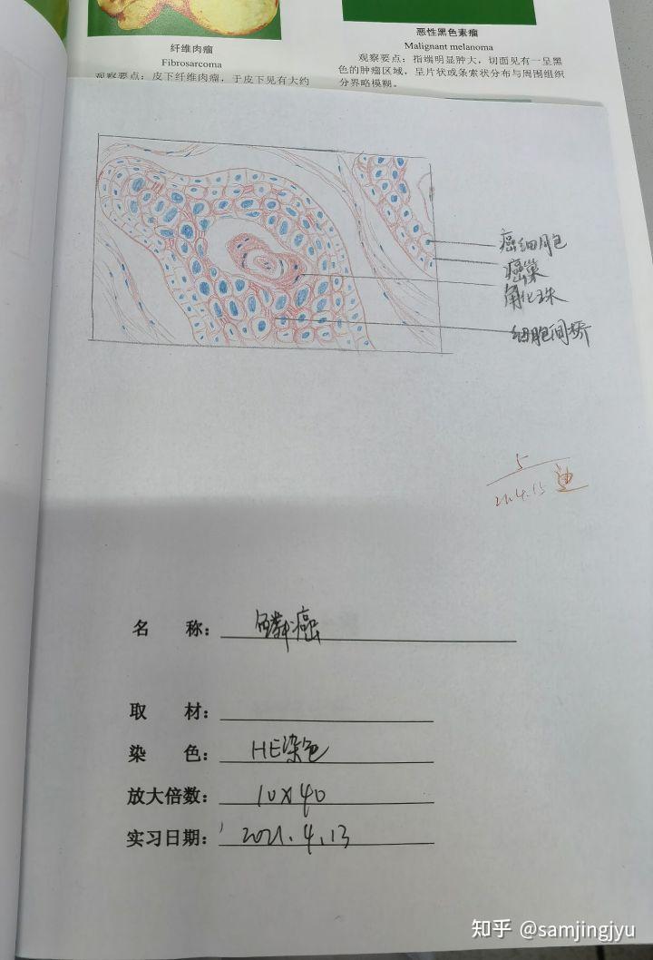 5.纤维肉瘤6.风湿性心肌炎7.大叶性肺炎8.肝硬化9.慢性肾小球肾炎10.