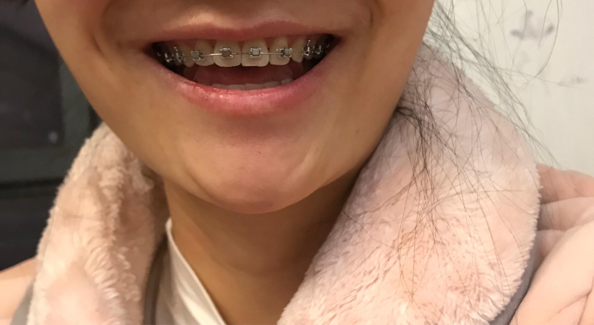 有没有人带牙套途中中线又歪又偏,左右两边牙齿还不一样长的?