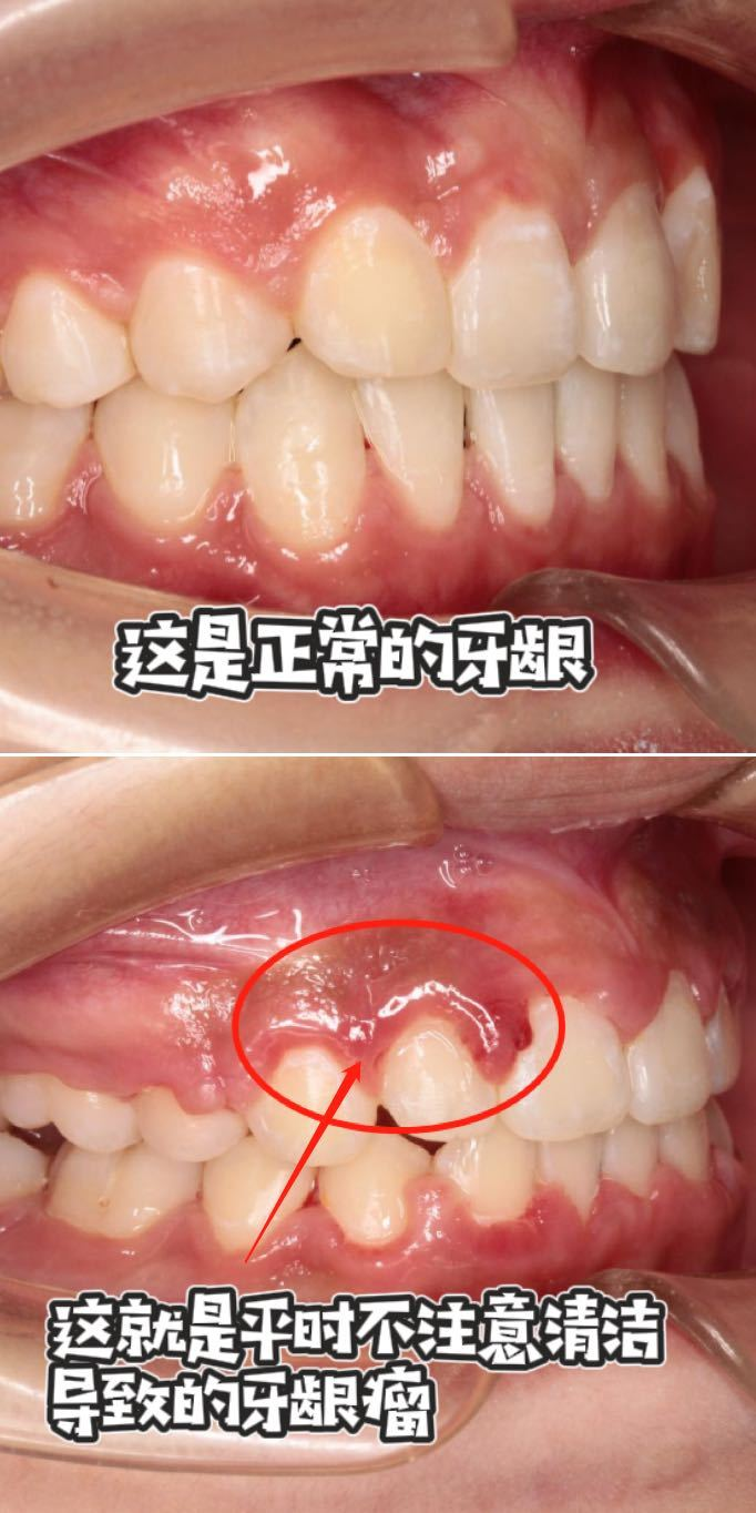 正常牙龈的图片侧面图片