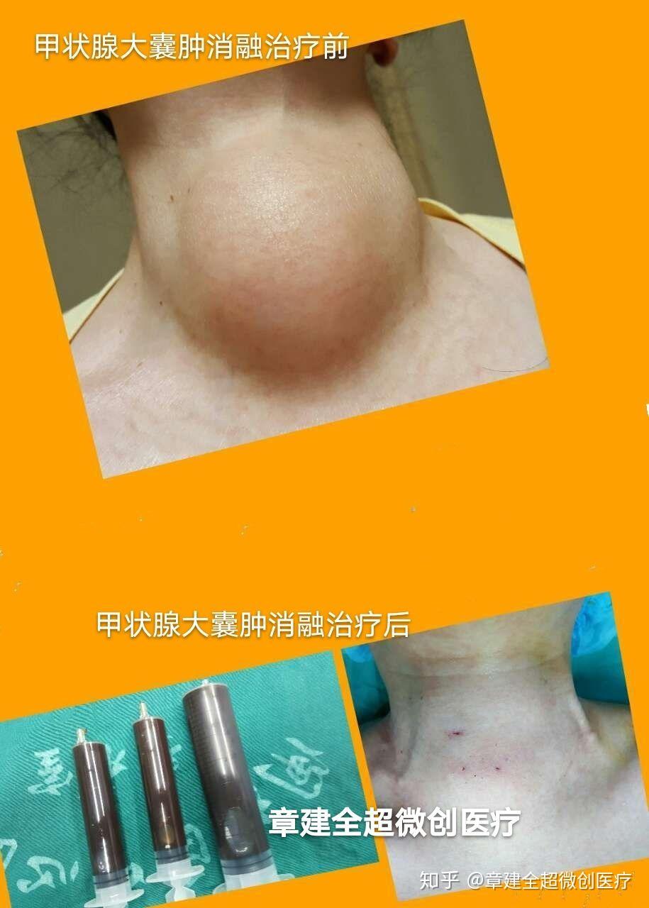 甲状腺大囊肿消融治疗
