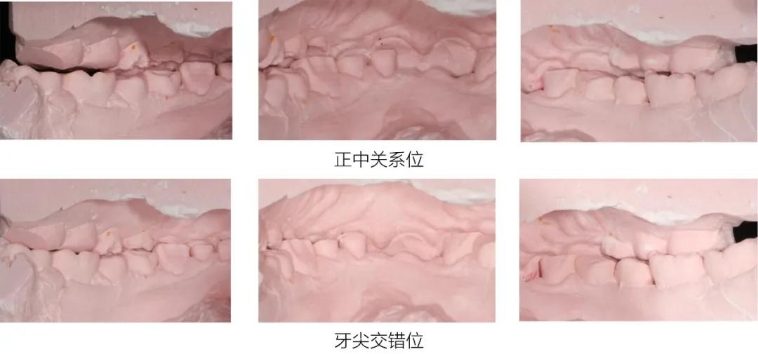 正中关系位到牙尖交错位存在偏移;磨耗病因分析41,42拔除后阶段二