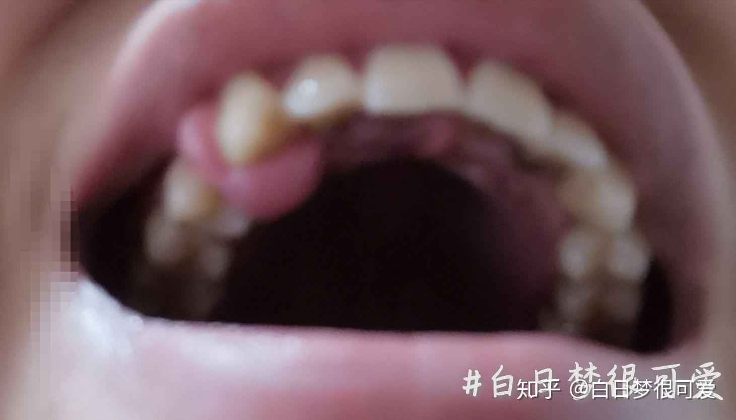 什么是牙龈瘤？ - 知乎