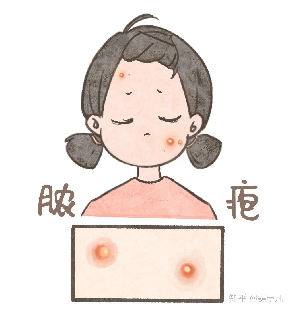 痘痘的形成原因痘痘的分级及注意事项