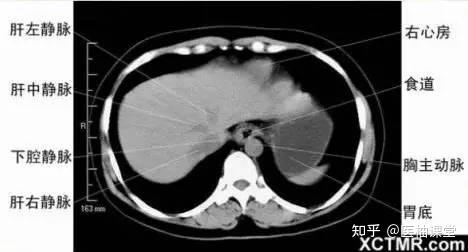 【收藏】胸、腹、盆腔 CT解剖详解 - 知乎