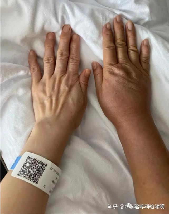 右手治疗前后对比:略有肿胀为术后轻度炎症水肿,原曲张静脉基本消退