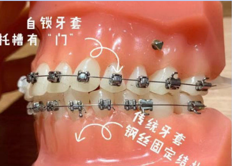 牙套(1)金属非自锁牙套(传统牙套):需要钢丝来把弓丝和托槽结扎固定