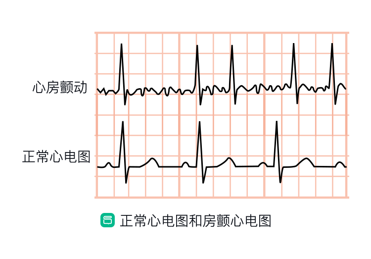 房颤与室颤,“傻傻分不清楚”? - 知乎