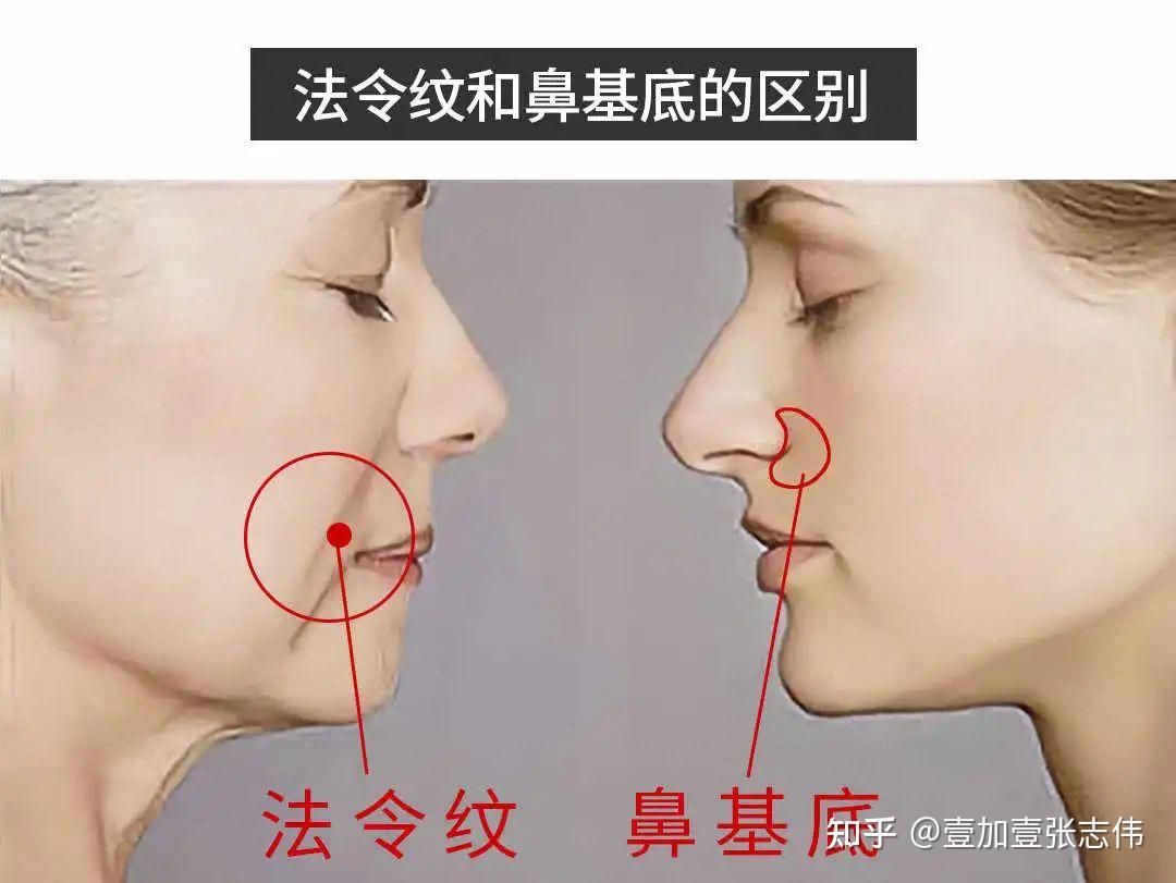 改善鼻基底凹陷哪种方法更合适