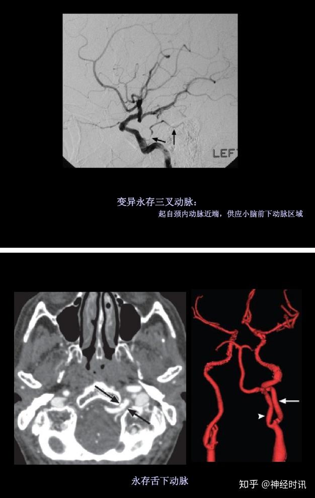 【干货推荐】图解脑动脉的正常变异