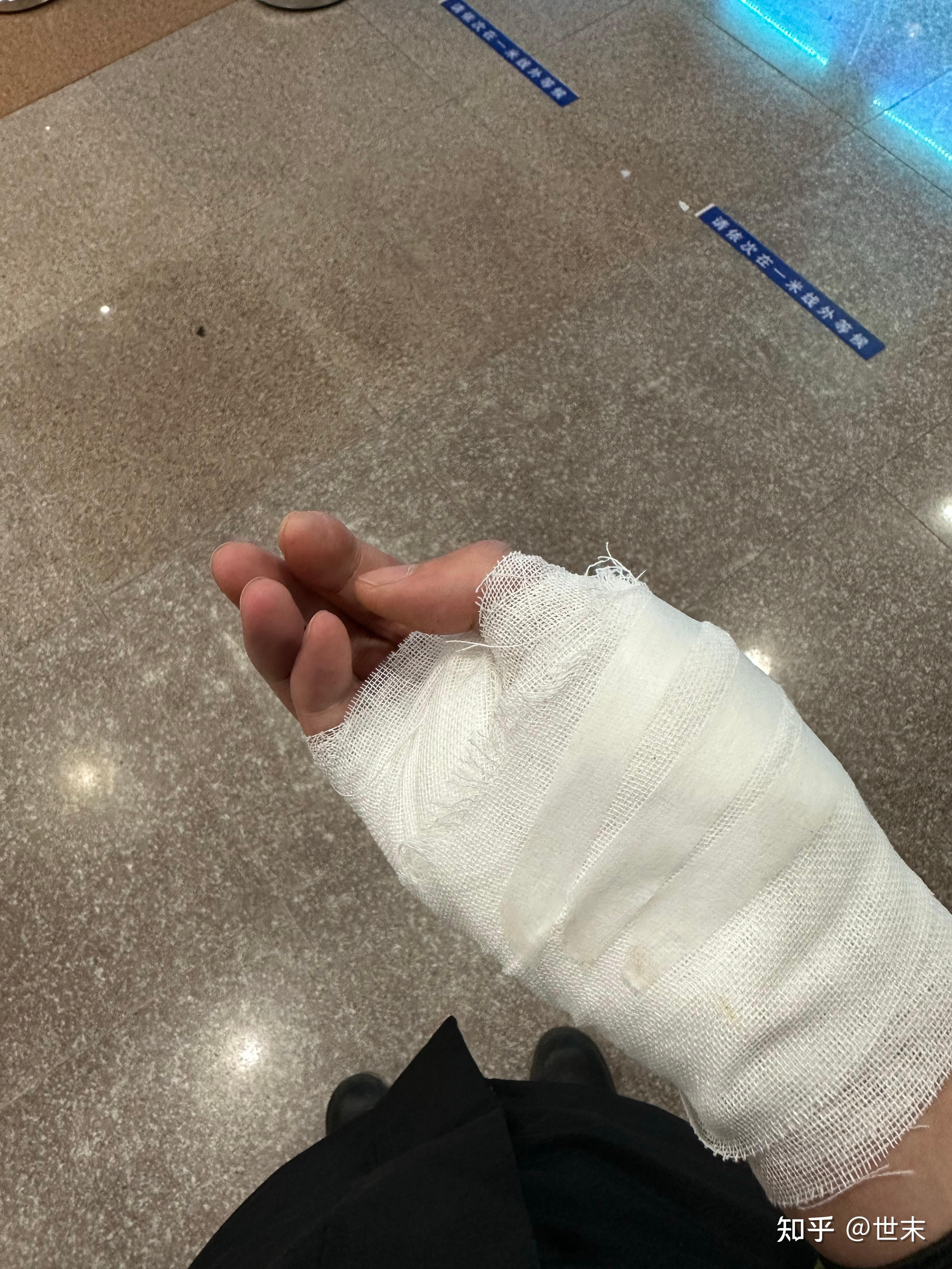 手指屈筋腱損傷（しゅし くっきんけん そんしょう） | 福岡の弁護士による後遺障害・等級認定サポート